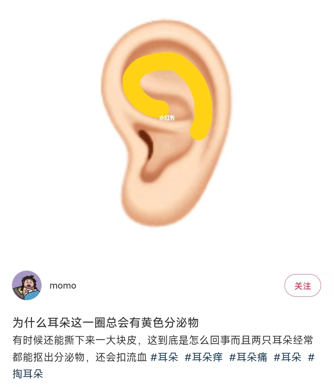 真的想问：耳朵周围黄黄的分泌物，到底是什么？